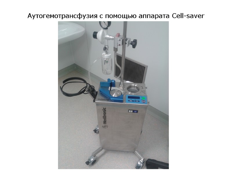 Аутогемотрансфузия с помощью аппарата Cell-saver